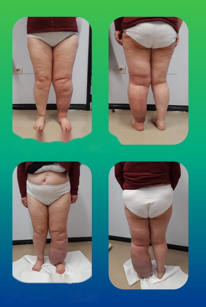 Riduzione del linfedema agli arti inferiori con terapia decongestiva a Torino