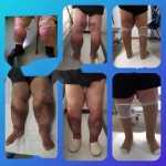 Scopri di più sull'articolo Fisioterapia per linfedema e lipedema a Torino: la guida completa