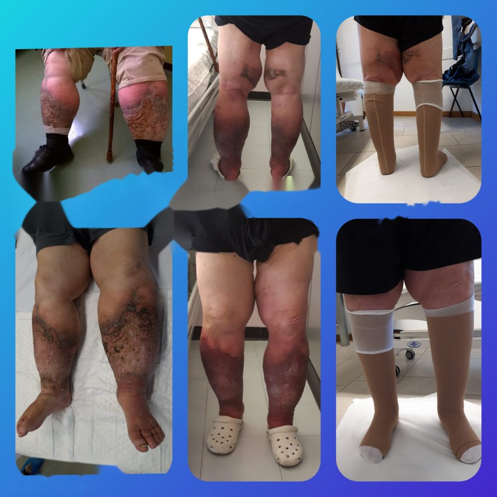 Linfedema agli arti inferiori prima e dopo la terapia decongestiva complessa a Torino